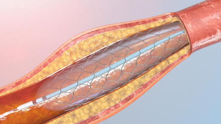【最智慧商学院】好消息！冠脉支架集采价降至千元以下 医疗高值耗材市场洗牌 这一投资机会显露